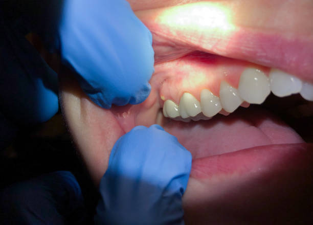 Best Emergency Root Canal Treatment in Corbin, KY
